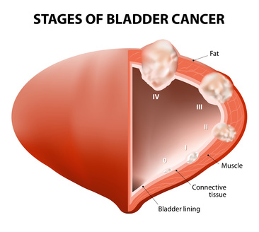 cancer bladder