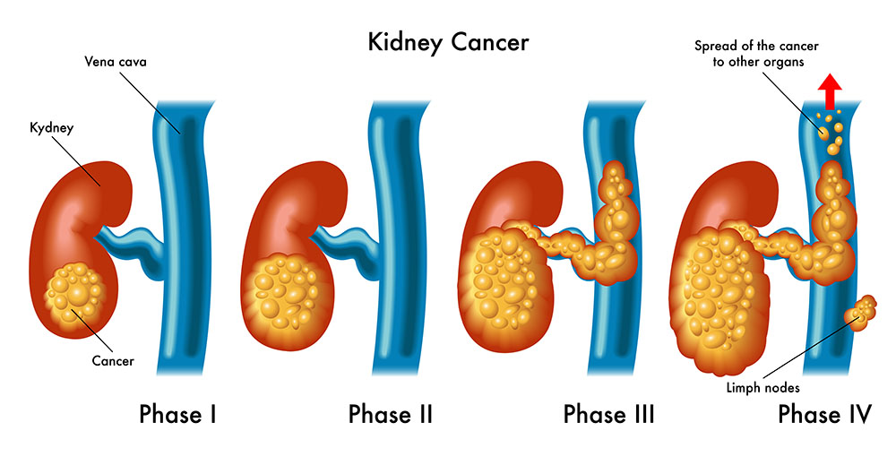 latest research on kidney cancer